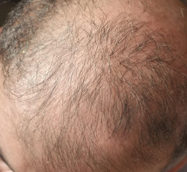 Cómo evitar la caída del pelo