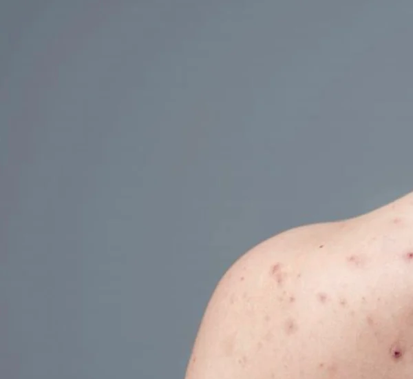 Remedio casero para eliminar verrugas con aloe vera, limón y ajo. Mezcla natural con propiedades curativas.