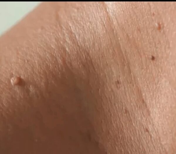 Verrugas pequeñas en la piel del cuello, también conocidas como acrocordones.