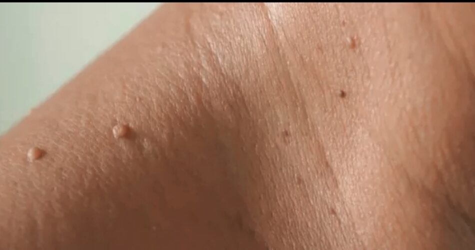 Verrugas pequeñas en la piel del cuello, también conocidas como acrocordones.