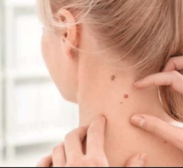 Quitar verrugas del cuello fácilmente