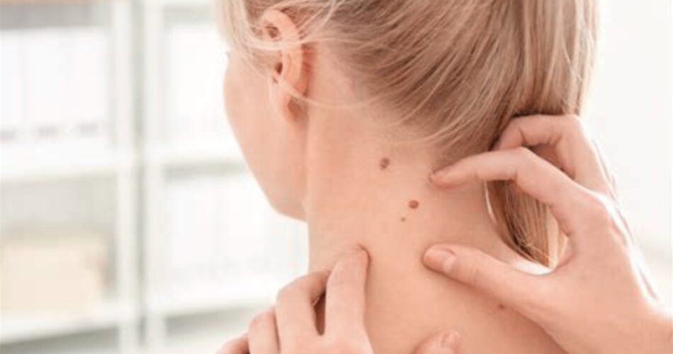 Quitar verrugas del cuello fácilmente