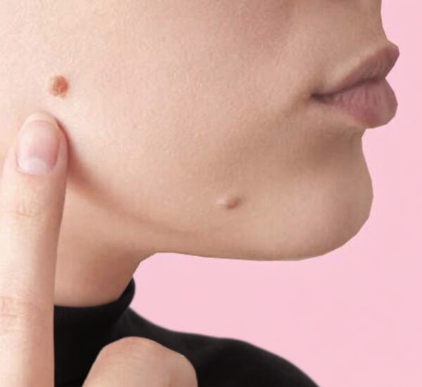 Tipos de verrugas en la piel